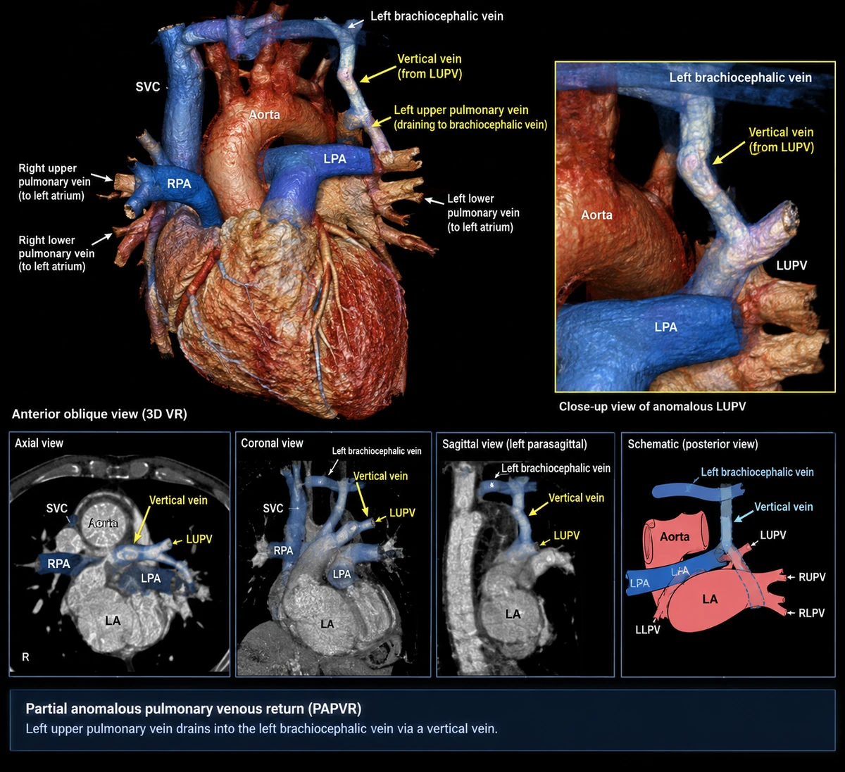 GPT-Image 2.5 生成的 PAPVR 心臟血管 3D 重組影像與斷層切面，含英文標示